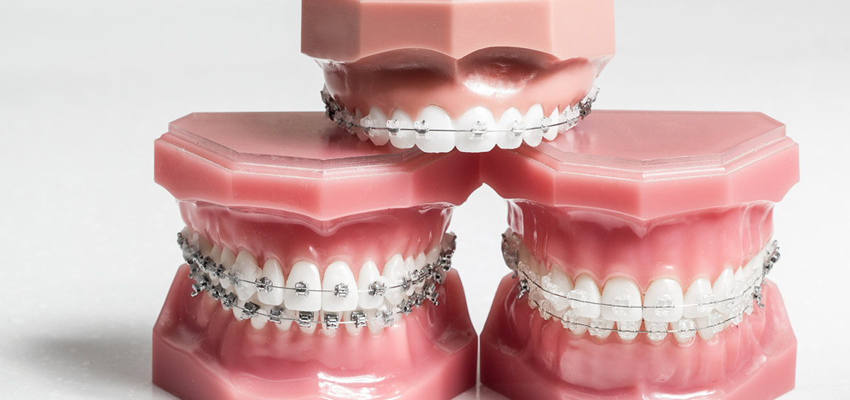 brackets-esteticos-convencionales