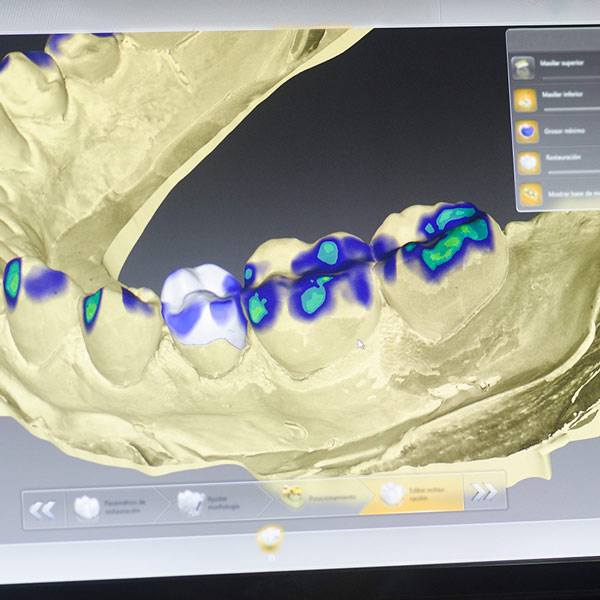 implantes guiados por ordenador