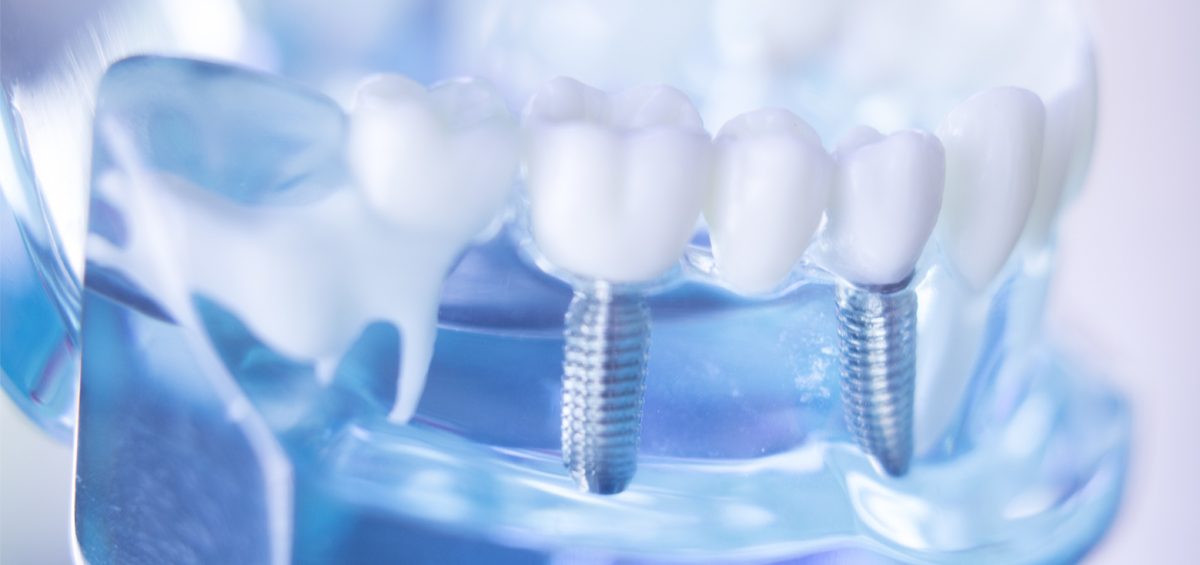 Implantes dentales inmediatos