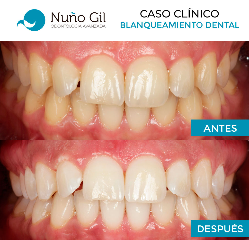 caso-clinico-2-blanqueamiento-dental-profesional-clinica-dental-nuno-gil