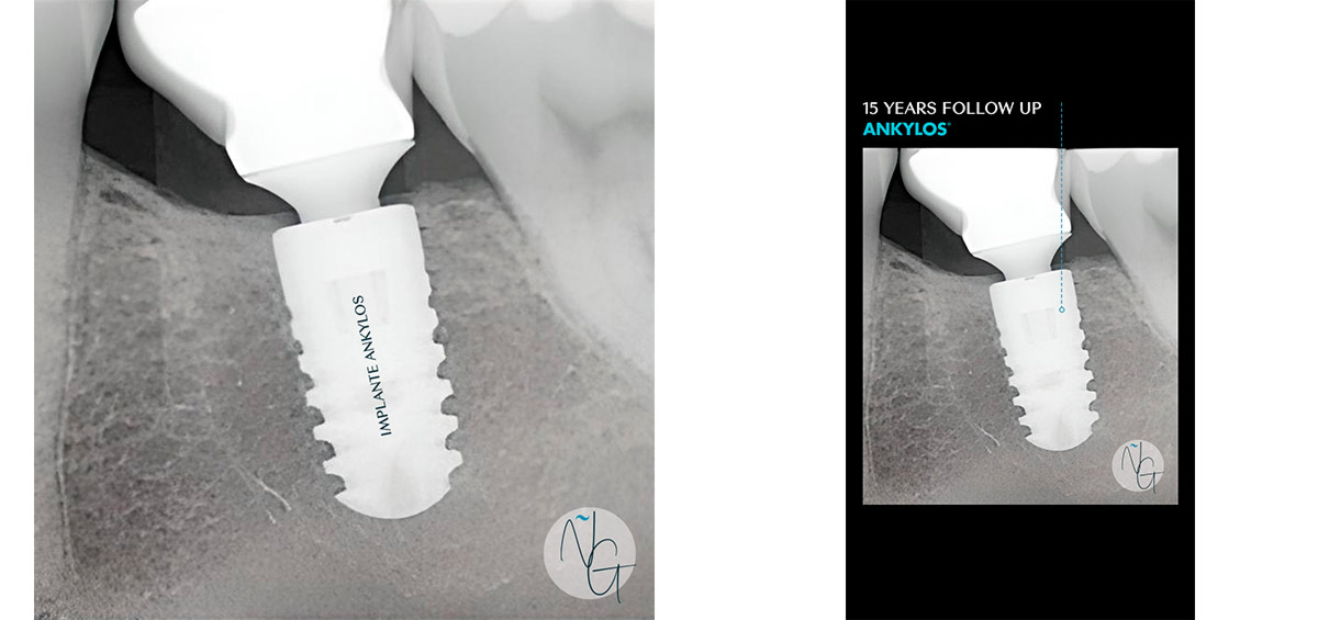 Radiografía duración implante dental
