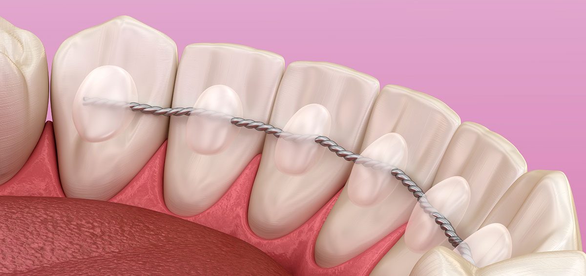 retenedor fijo de ortodoncia