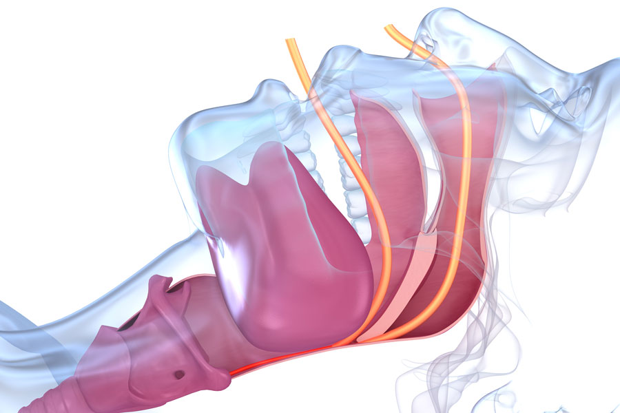 Síndrome de apnea del sueño. Ilustración 3D.