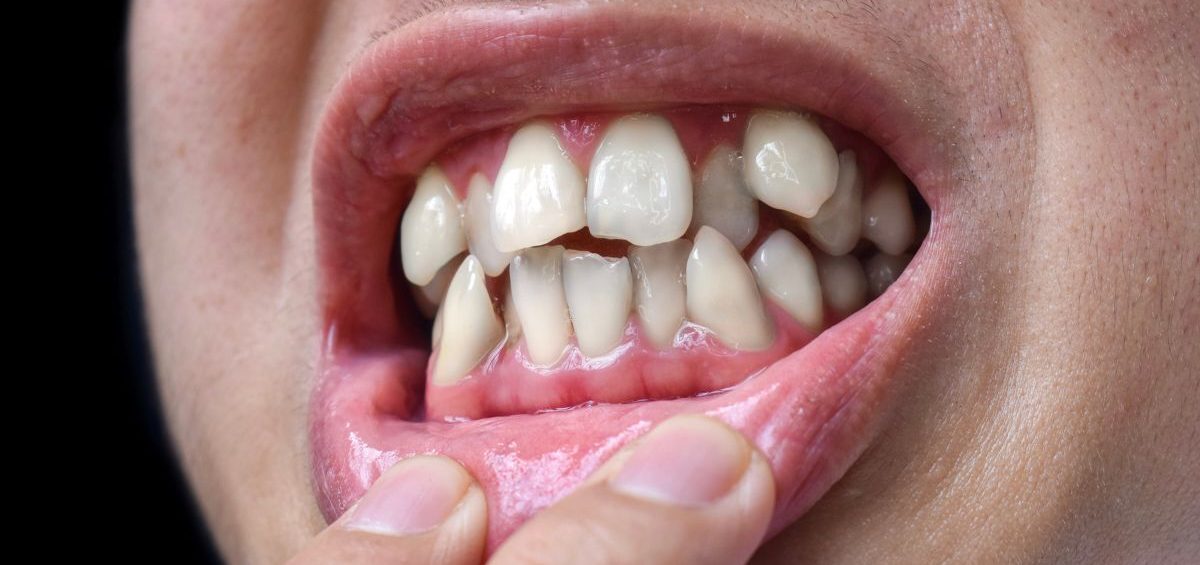 dientes-apinados