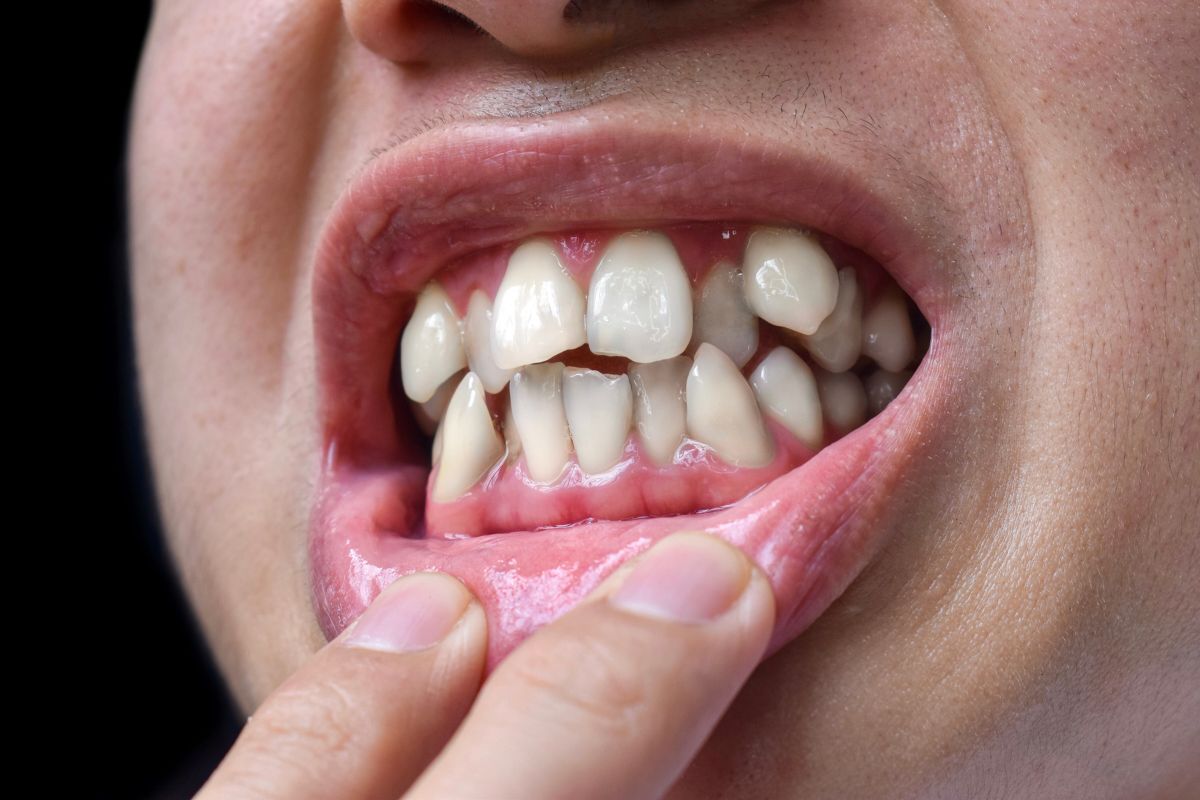 dientes-apinados
