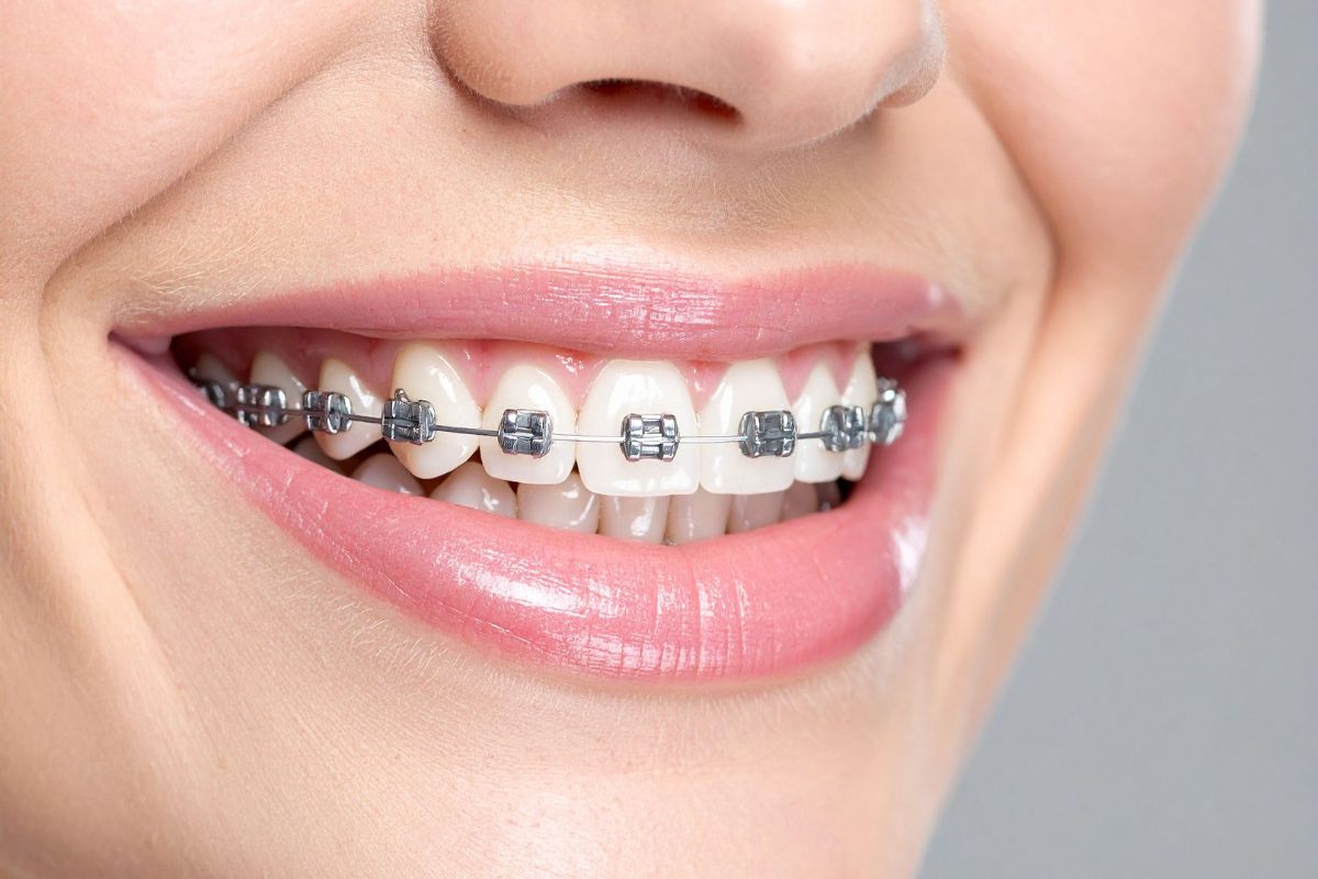 ortodoncia-brackets-metalicos