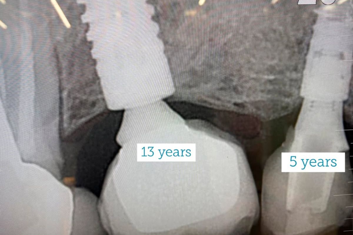 implantes-dentales-osteointegrados
