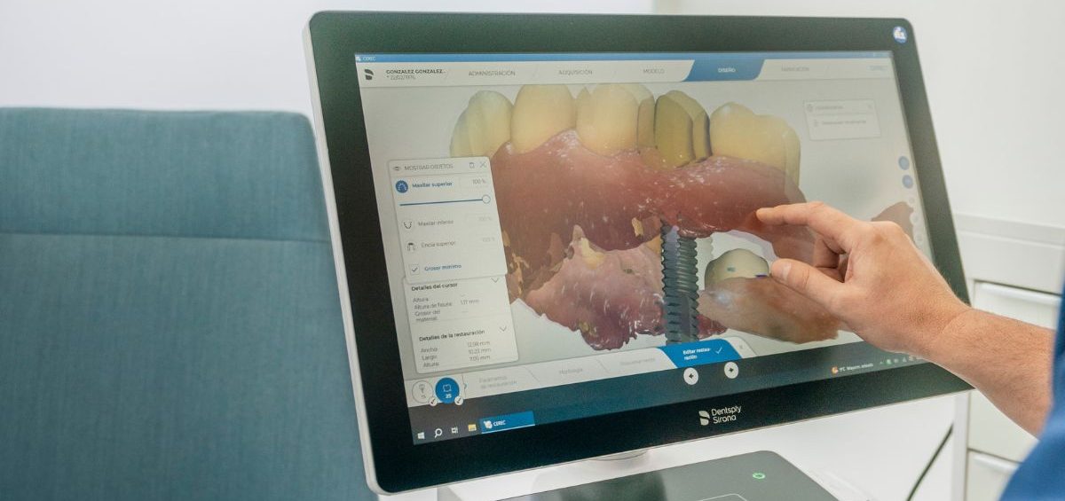 se-mueven-implantes-dentales