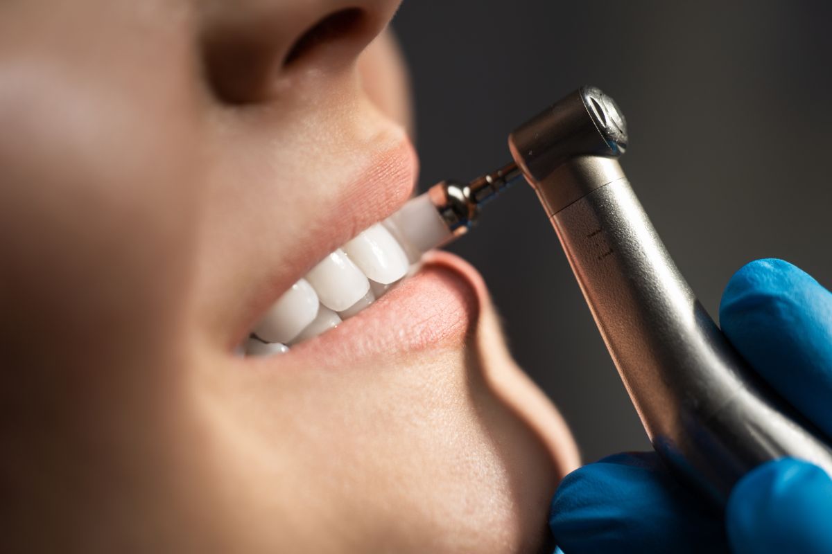 pulido-superficie-dental