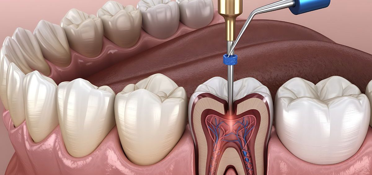 endodoncia-con-infeccion
