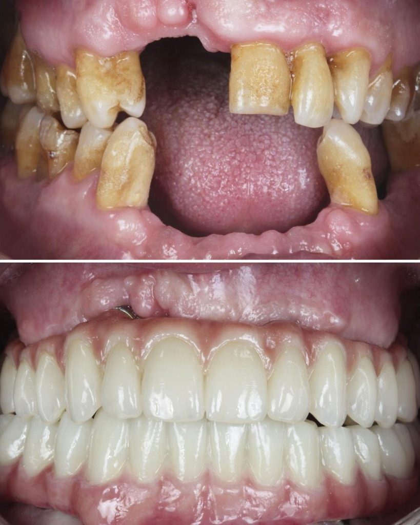 Antes y después caso clínico rehabilitación oral completa