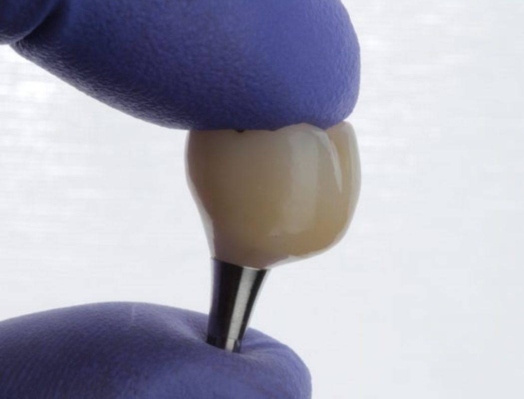 restauración definitiva del diente tras implantes