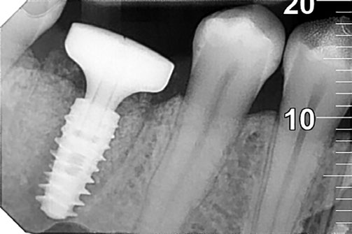 Aspecto radiográfico del periodo de osteointegración.