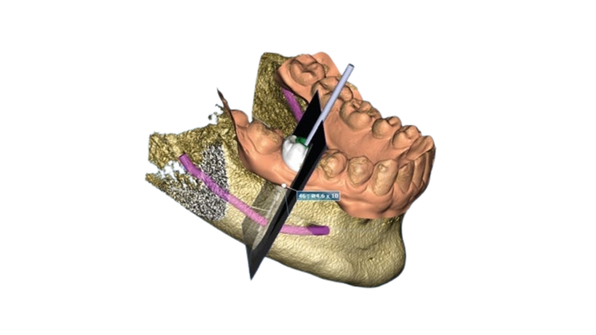 planificación quirúrgica para implantes dentales